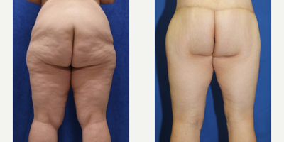 Case 7098 - 45-54 year old woman treated with Thigh Lift