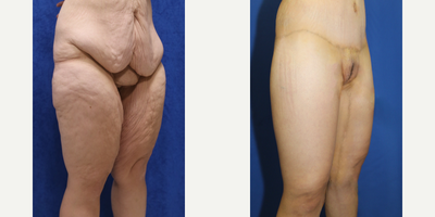 Case 7099 - 45-54 year old woman treated with Thigh Lift