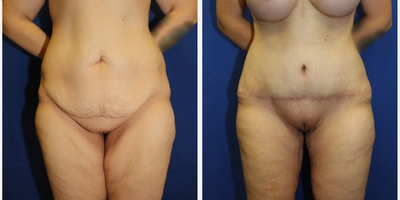 Case 71 - Woman treated with Tummy Tuck
