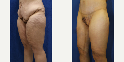 Case 7100 - 45-54 year old woman treated with Thigh Lift