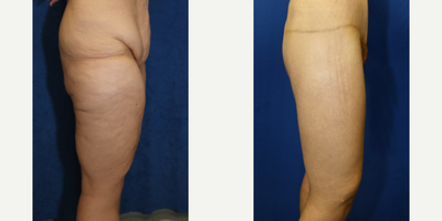 Case 7101 - 45-54 year old woman treated with Thigh Lift