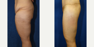 Case 7102 - 45-54 year old woman treated with Thigh Lift