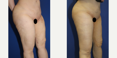 Case 7103 - 35-44 year old woman treated with Thigh Lift
