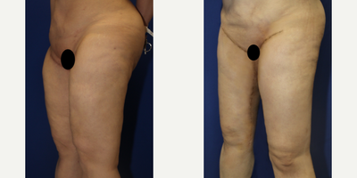 Case 7104 - 35-44 year old woman treated with Thigh Lift
