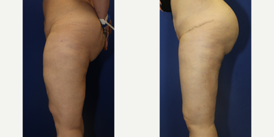 Case 7105 - 35-44 year old woman treated with Thigh Lift