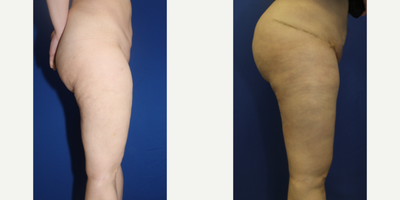 Case 7106 - 35-44 year old woman treated with Thigh Lift