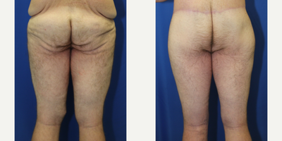 Case 7107 - 25-34 year old man treated with Thigh Lift