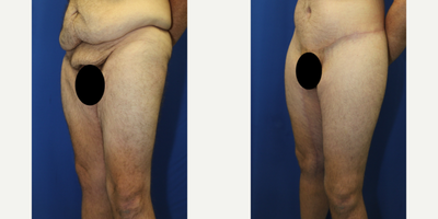 Case 7108 - 25-34 year old man treated with Thigh Lift