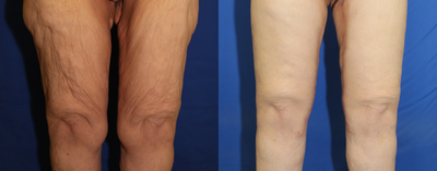 Case 7109 - 45-54 year old woman treated with Thread Lift