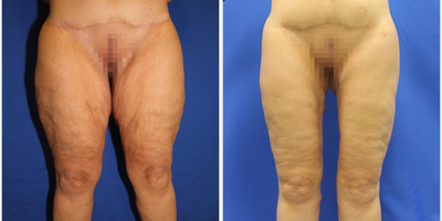 Case 7110 - 45-54 year old woman treated with Thigh Lift