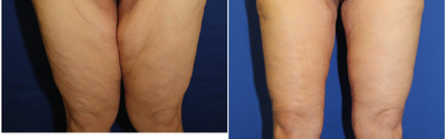 Case 7115 - 25-34 year old woman treated with Thigh Lift