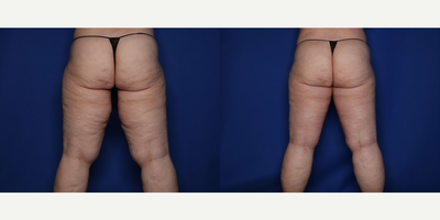 Case 7116 - 42 year old woman treated with Thigh Lift