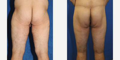 Case 7117 - 45-54 year old man treated with Thigh Lift
