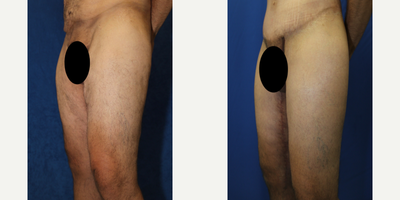 Case 7118 - 45-54 year old man treated with Thigh Lift