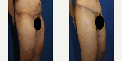Case 7119 - 45-54 year old man treated with Thigh Lift