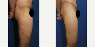 Case 7120 - 45-54 year old man treated with Thigh Lift