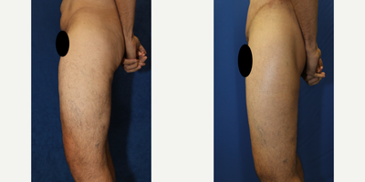 Case 7121 - 45-54 year old man treated with Thigh Lift