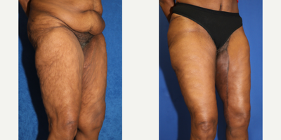 Case 7123 - 55-64 year old woman treated with Thigh Lift