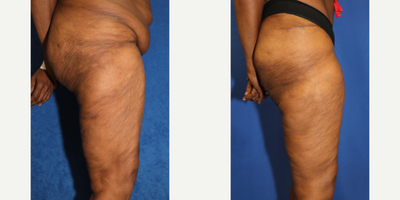 Case 7124 - 55-64 year old woman treated with Thigh Lift