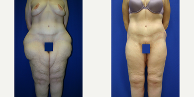 Case 7125 - 35-44 year old woman treated with Thigh Lift