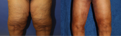 Case 7126 - 35-44 year old woman treated with Thigh Lift