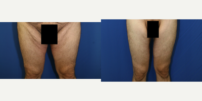 Case 7127 - 35-44 year old man treated with Thigh Lift