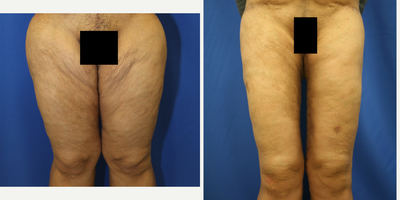 Case 7128 - 55-64 year old woman treated with Thigh Lift
