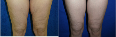 Case 7130 - Crescent Thigh Lift 