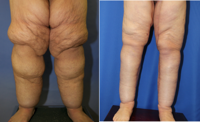 Case 7132 - Thigh Lift 18