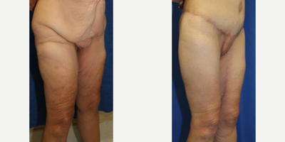 Case 7133 - 55-64 year old woman treated with Thigh Lift