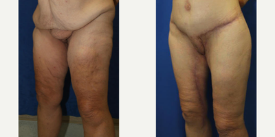 Case 7134 - 55-64 year old woman treated with Thigh Lift
