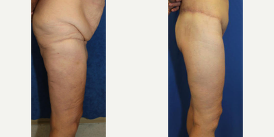 Case 7135 - 55-64 year old woman treated with Thigh Lift