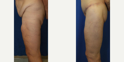Case 7136 - 55-64 year old woman treated with Thigh Lift