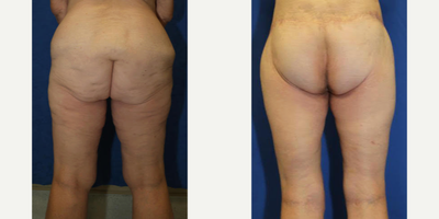 Case 7137 - 55-64 year old woman treated with Thigh Lift
