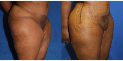Case 7138 - 35-44 year old woman treated with Thigh Lift