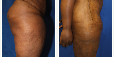 Case 7139 - 35-44 year old woman treated with Thigh Lift