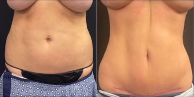 Case 714 - Woman treated with Mini-Tummy Tuck and Hi-Definition Liposuction 