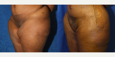Case 7140 - 35-44 year old woman treated with Thigh Lift