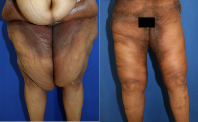 Case 7141 - Thigh Lift
