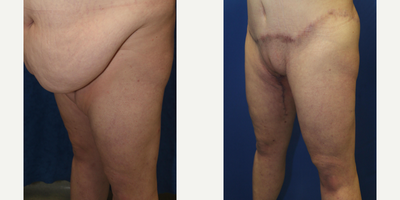 Case 7142 - 25-34 year old woman treated with Thigh Lift