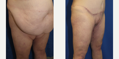 Case 7143 - 25-34 year old woman treated with Thigh Lift