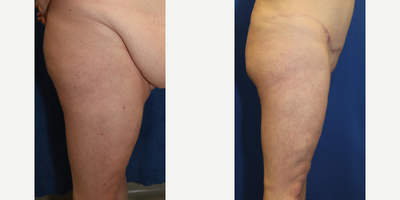 Case 7144 - 25-34 year old woman treated with Thigh Lift
