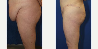 Case 7145 - 25-34 year old woman treated with Thigh Lift