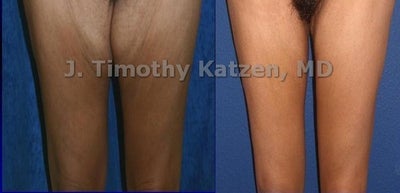 Case 7147 - Thigh Lift after massive weight loss