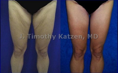 Case 7148 - Thigh Lift after massive weight loss