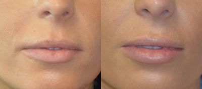Case: 7149 - before and after photo of 25-34 year old woman treated with Lip Implants by James Chan, MD