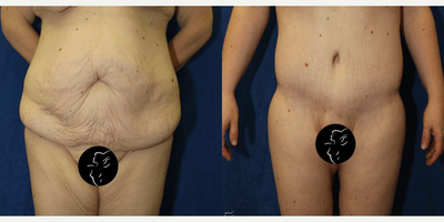 Case 715 - 35-44 year old woman treated with Tummy Tuck