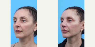 Case: 7150 - before and after photo of Woman treated with Eyelid Surgery, Facelift, Neck Lift, Lip Lift, Lip Implants, Rhinoplasty by Caitlin Iorio, MD