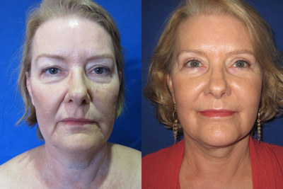 Case: 7151 - before and after photo of 50-59 year old woman treated with Lip Implants by Vu Ho, MD