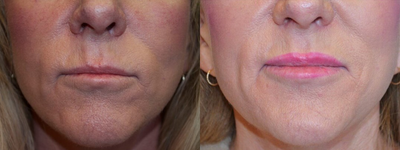 Case: 7152 - before and after photo of 50-59 year old woman treated with Lip Implants by Vu Ho, MD